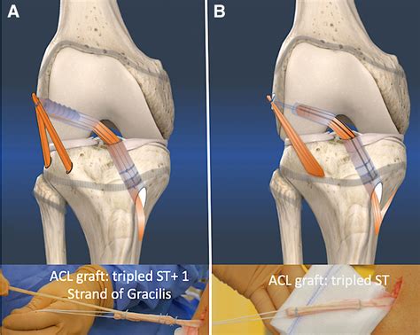 acl surgery greenwich|ACL Rehabilitation .